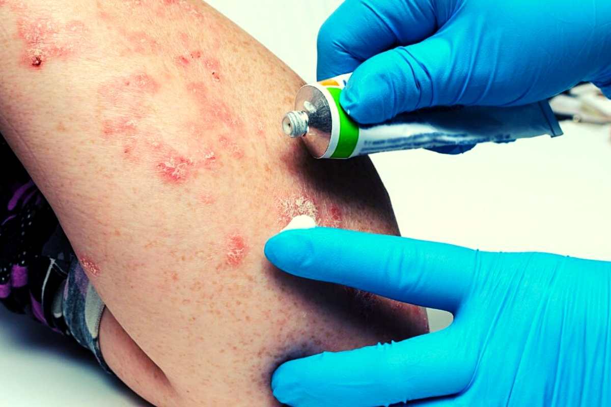 7 common treatments for psoriasis – Spring of Science